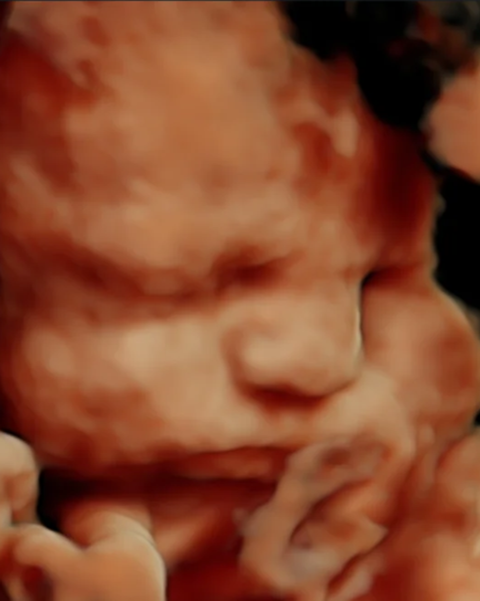 HD Live ultrasound face scan, Perfect Preview 3D